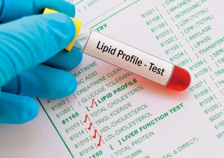 Lipid Profile Test