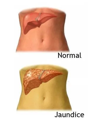 Treatment for Jaundice, and Stomach Disorders